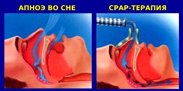 CPAP-терапия во сне - схема