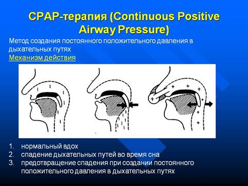 Эффект воздействия от CPAP-терапии